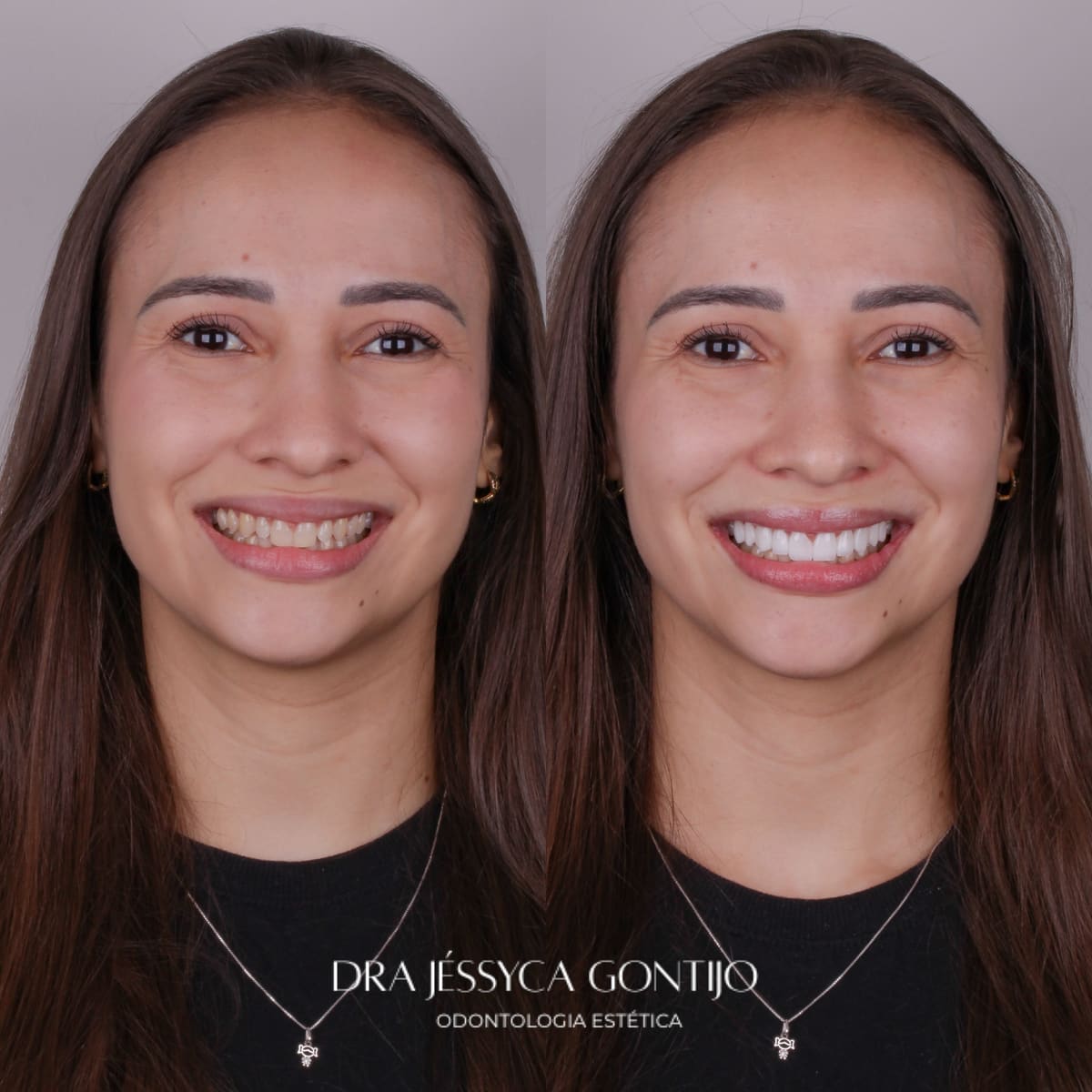 Antes e depois, caso 1