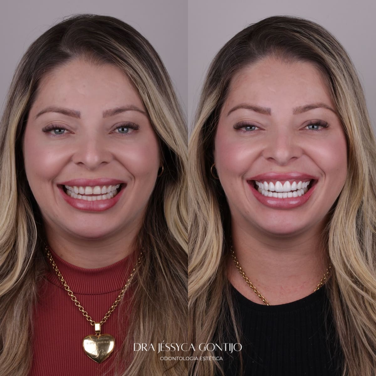 Antes e depois, caso 4
